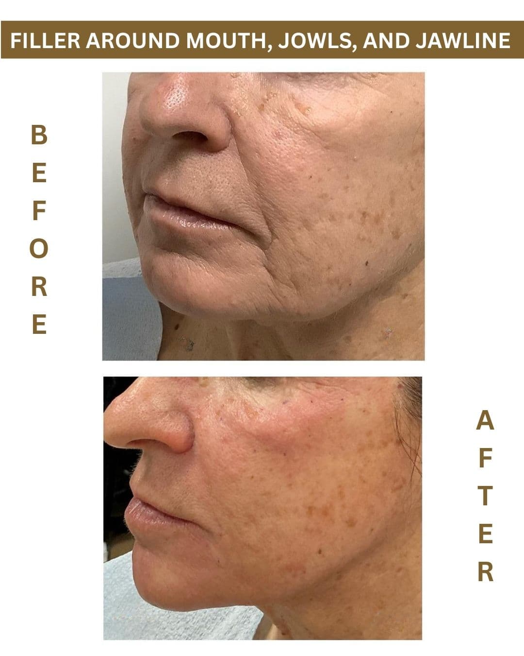 Before and after results for Laser Liposuction of Abdomen and Flank.