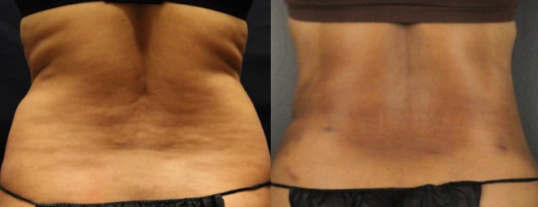 Before and after BeautiFill body contouring image of abdomen and flank.