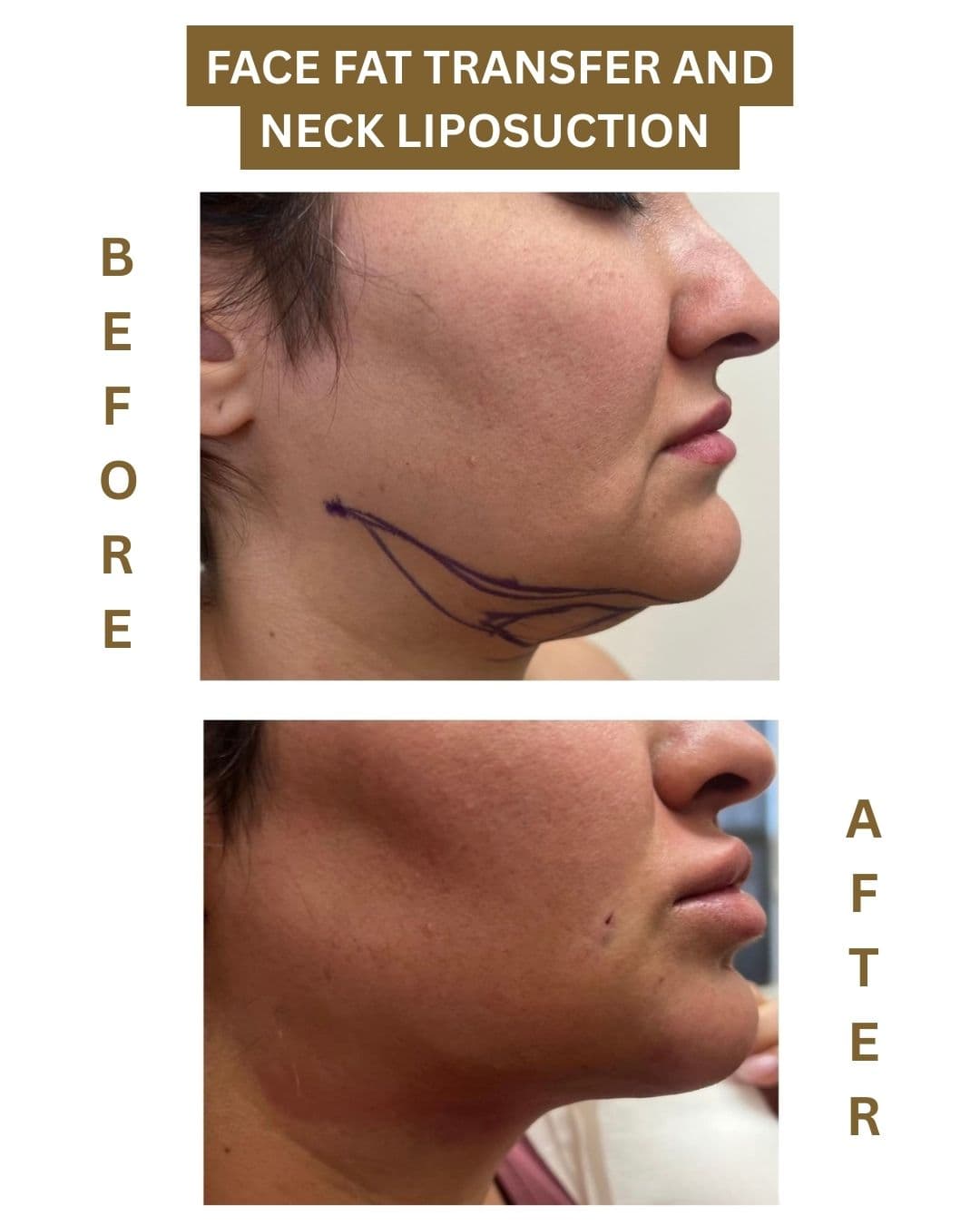 Before and after results for Face Fat Transfer and Neck Liposuction.