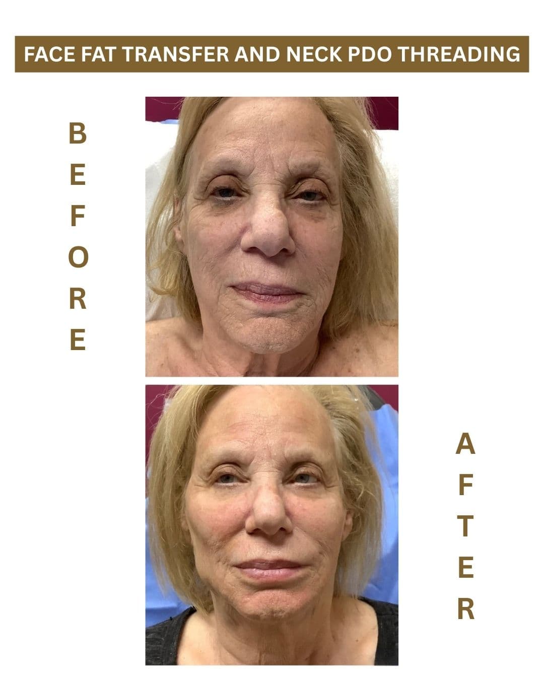 Front-view before and after results for Face Fat Transfer and Neck PDO Threading.