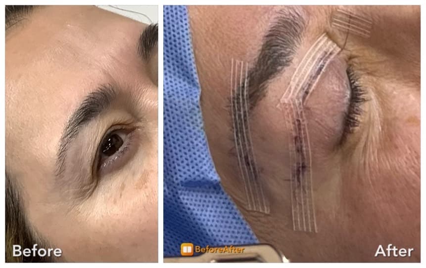 Before and after brow lift result showing elevated brow position and a more open eye area.