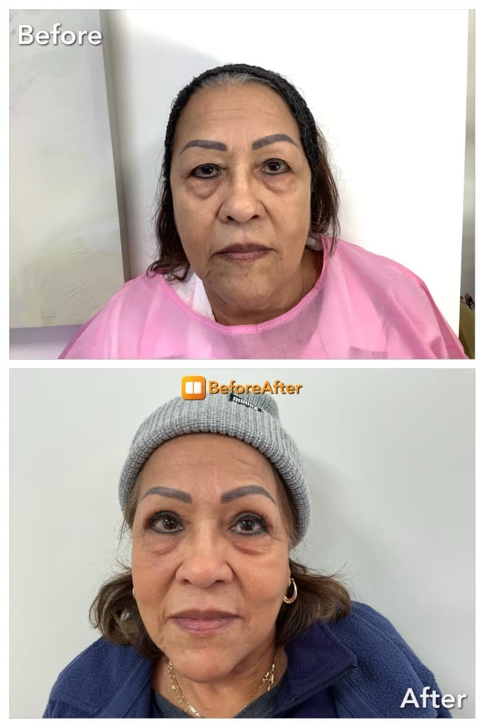Before and after eyelid and facial rejuvenation treatment with an overall refreshed upper-face appearance.